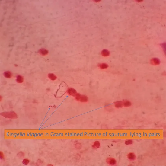 Kingella kingae Infection